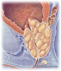 Тумор на простатата – причини, симптоми и лечение на заболяването
